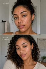 Acne Spot Treatment